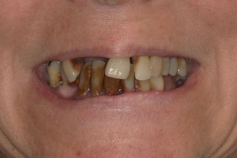 Full Mouth Dental Implants Generations Family Dentistry and Dental