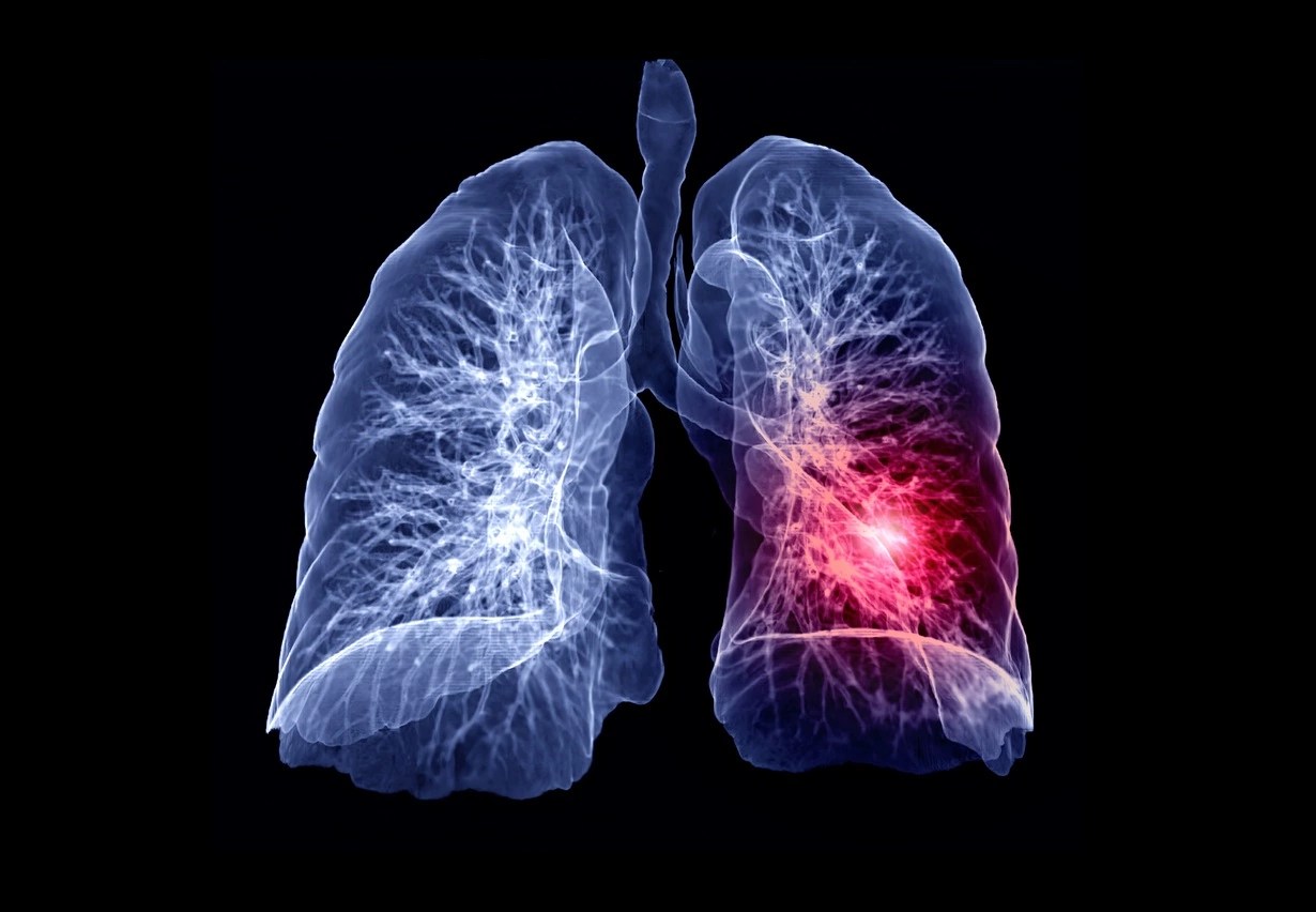 Study Demonstrates AntiAging Therapy for Pulmonary Fibrosis