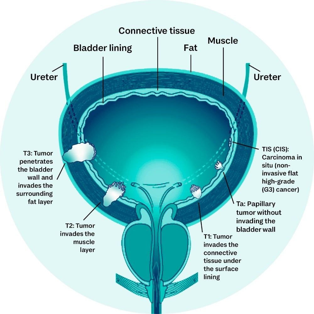 Bladder Cancer Grading