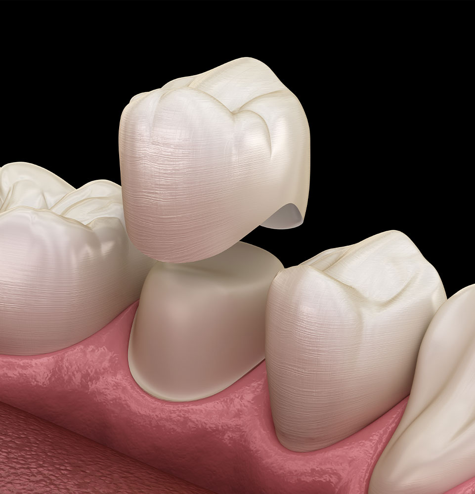 Dental Crowns & Bridges Hagerstown, MD Smile Design Centre