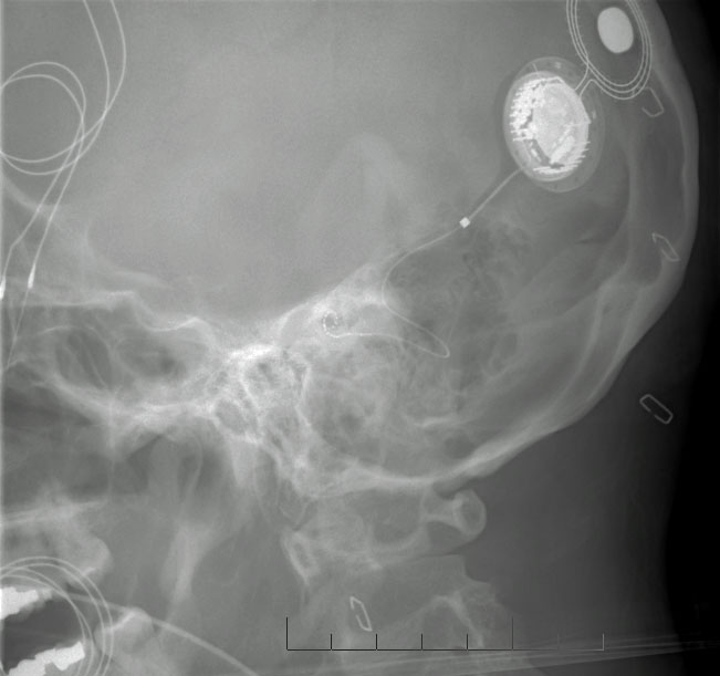 Surgery cochlear implant HELP