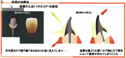 ファイバーコア 宇都宮（宇都宮市）の歯科・歯医者なら、ココ歯科クリニック
