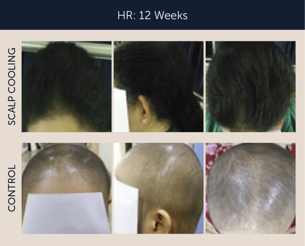 Hair regrowth with scalp cooling