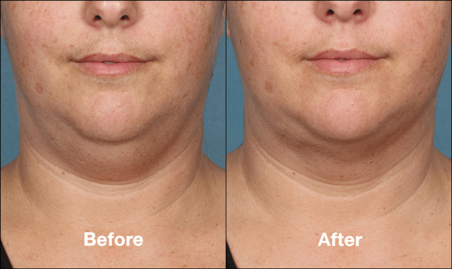 Kybella Injectables for Chin Fat Reduction Cost Atlanta Buckhead
