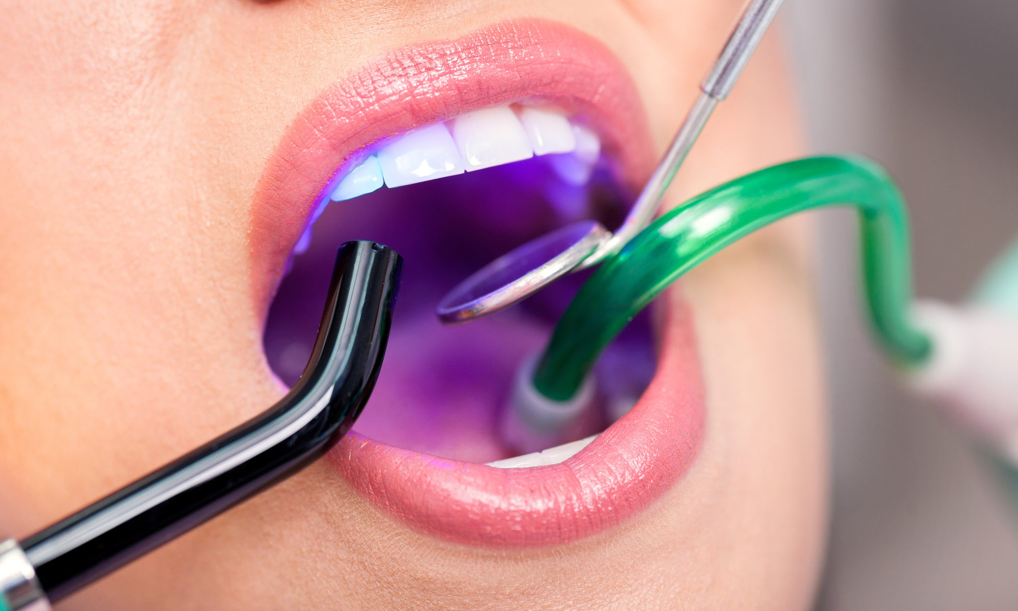 Laser Surgery Archives La Mesa Dentist Collaborative Dental Dr. Fung