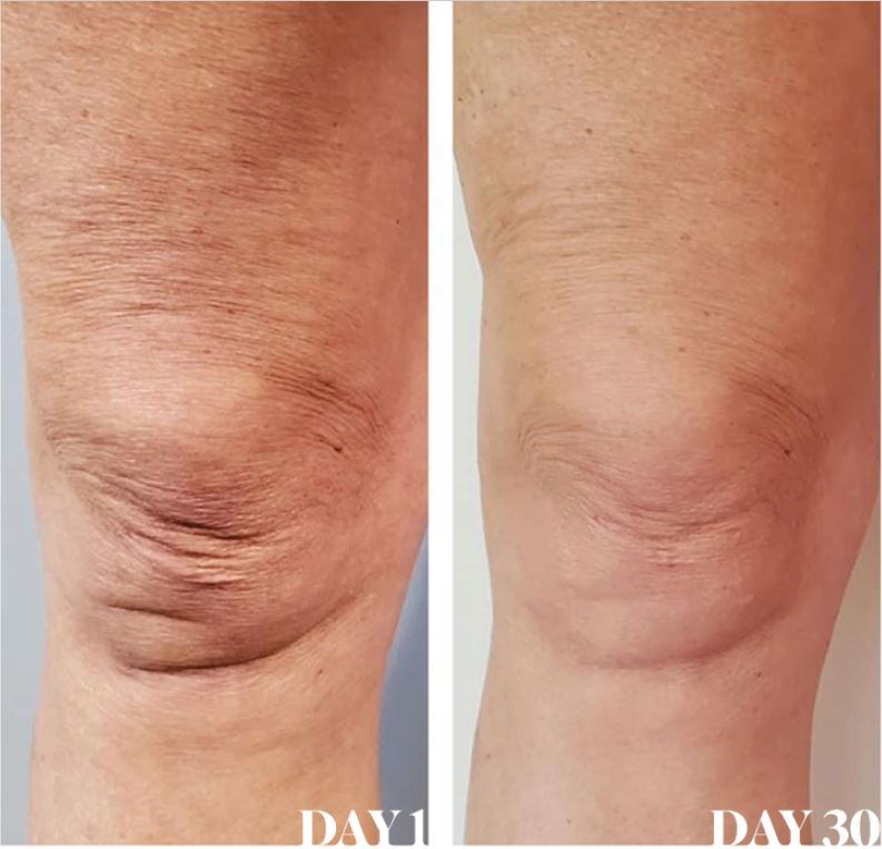 Collagen Before and After Pictures Do you see the Difference?