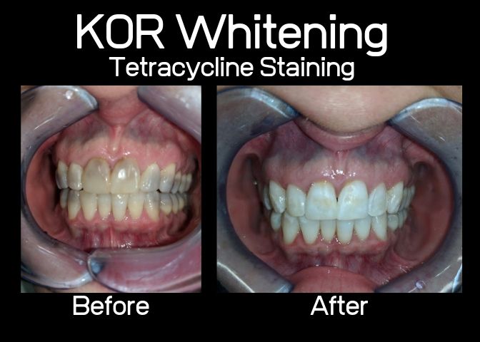 Collegeville KöR Whitening System Dentist Advanced Dentistry