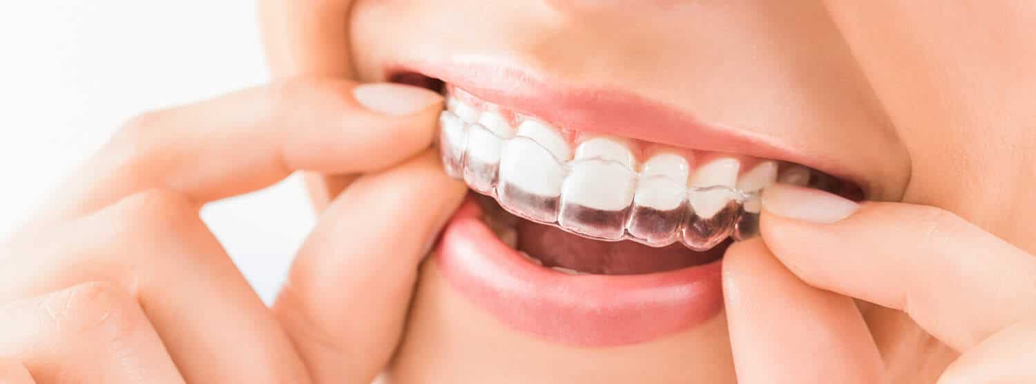 Invisalign Littleton, CO Invisalign Dentist Columbine Creek Dentistry