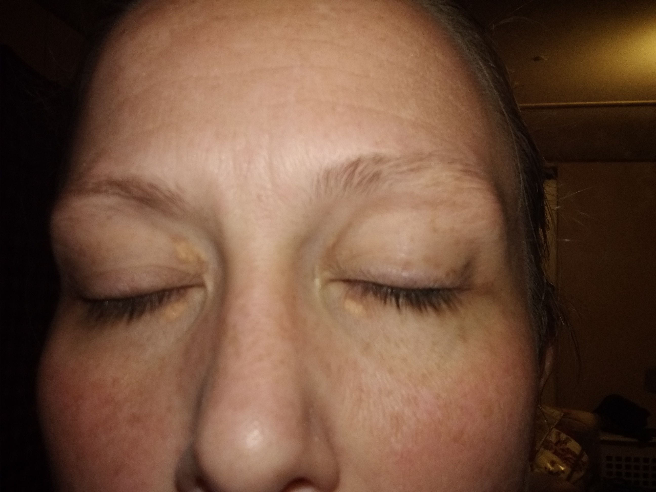 Under Eye Bumps, NOT milia Page 6 Beauty Insider Community
