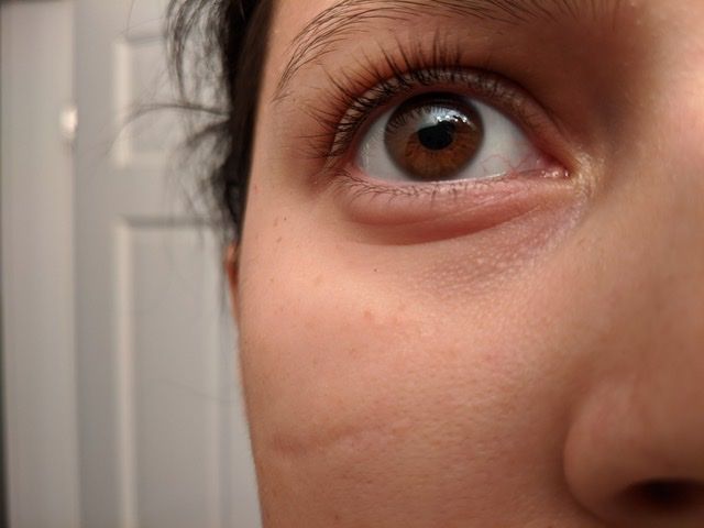 Under Eye Bumps, Not Milia - Beauty Insider Community