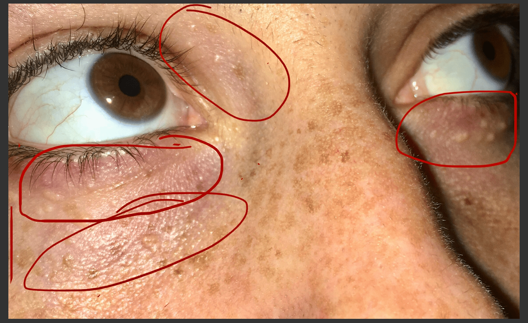 Under Eye Bumps, Not Milia - Beauty Insider Community