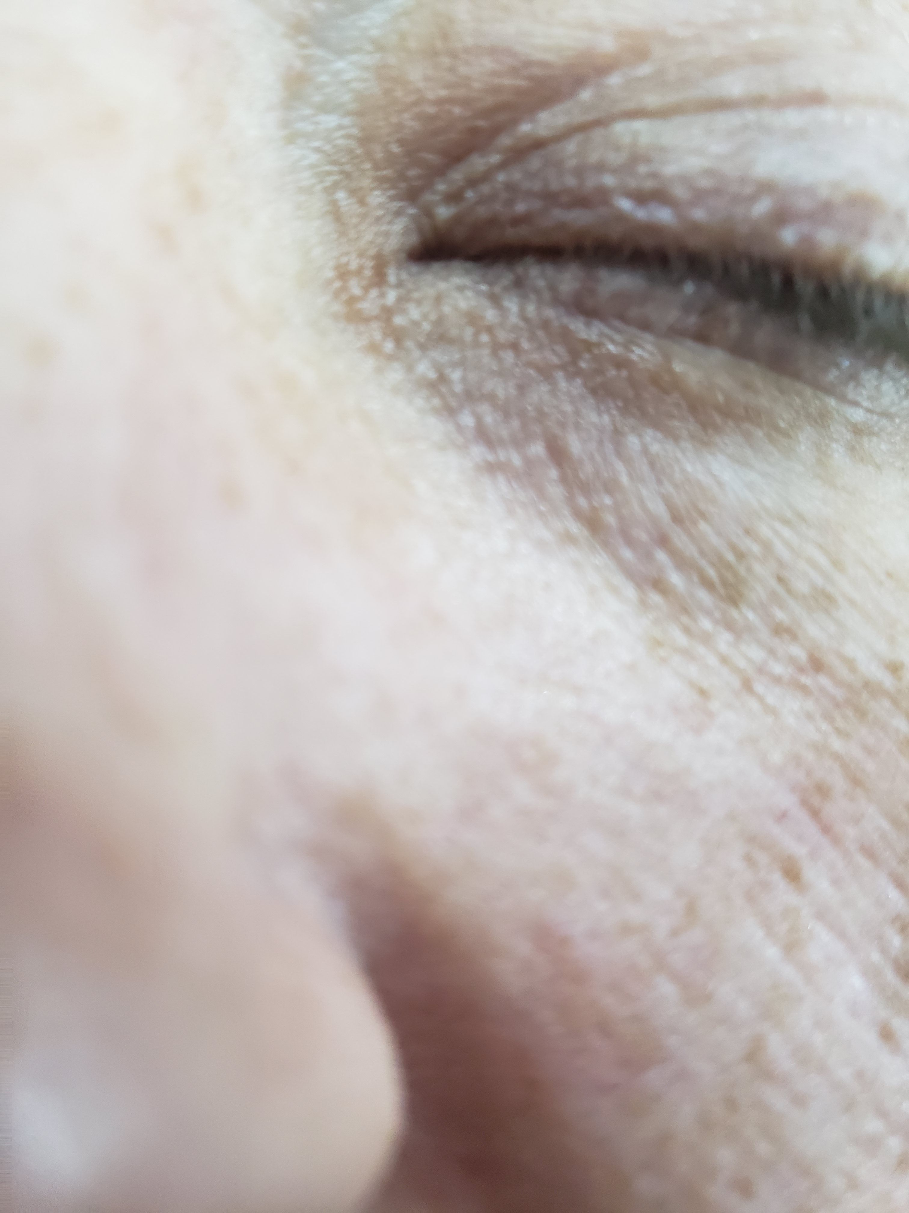 Under Eye Bumps, NOT milia Beauty Insider Community