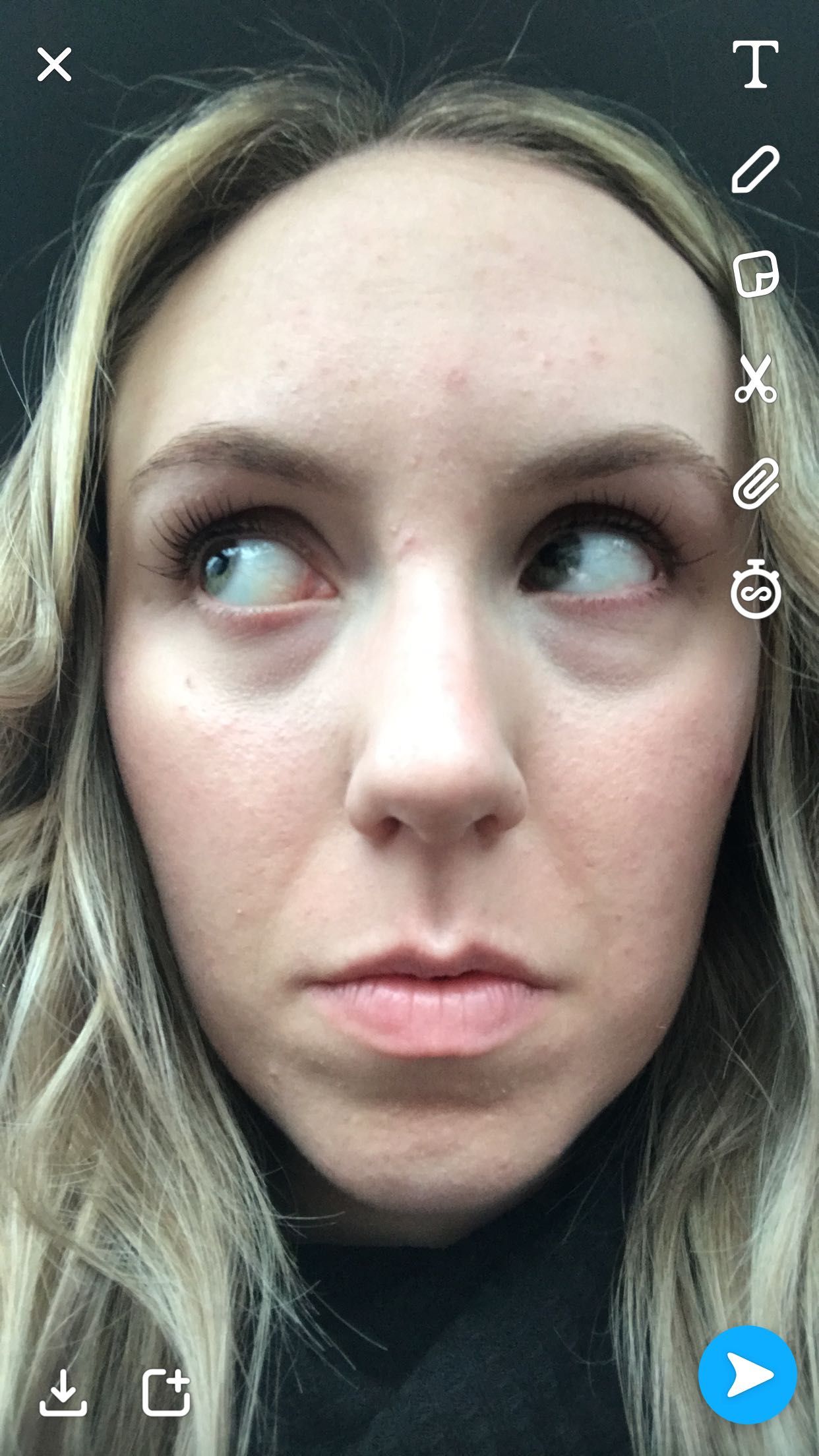 Help! Hereditary dark under eye circles Beauty Insider Community