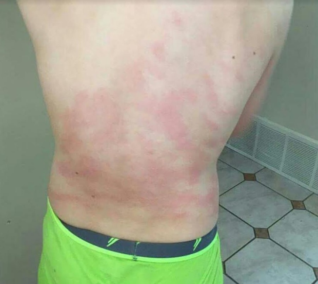 Allergic to water Grande Prairie boy diagnosed with rare disorder