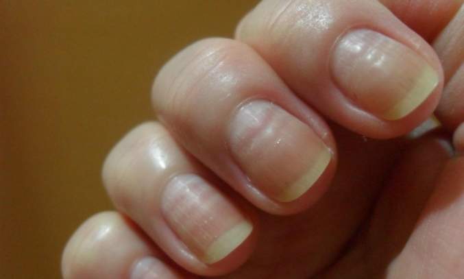 Unhas onduladas, como prevenir e tratar! Como Fazer as unhas