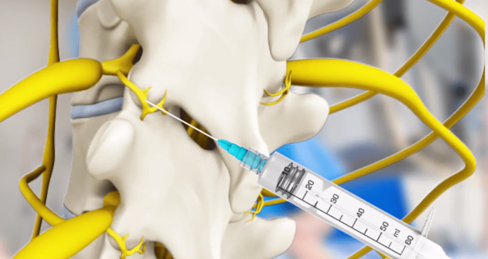 Medial Branch Nerve Blocks Comprehensive MD