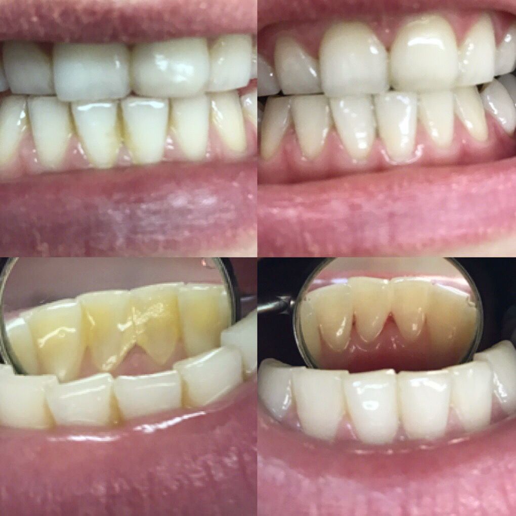 Stain removal v teeth whitening which is a brighter smile