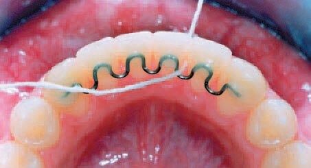 Permanent wires behind teeth make flossing difficult - what can I do
