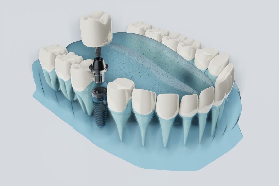 Best 2022 Dental Implant Options In South Africa Comparisonsmaster