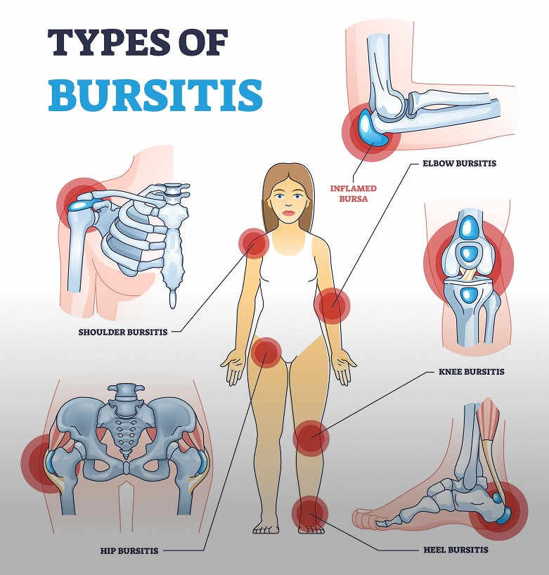 Bursitis: Causes, Diagnosis, And Advanced Treatments