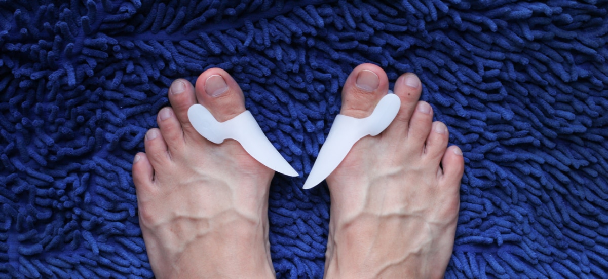 Do I Really Need Surgery for My Bunion? Comprehensive Foot Centers
