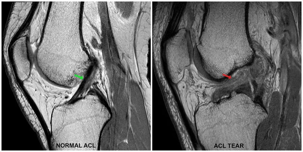 Anterior cruciate ligament (ACL) injury Complete Physio