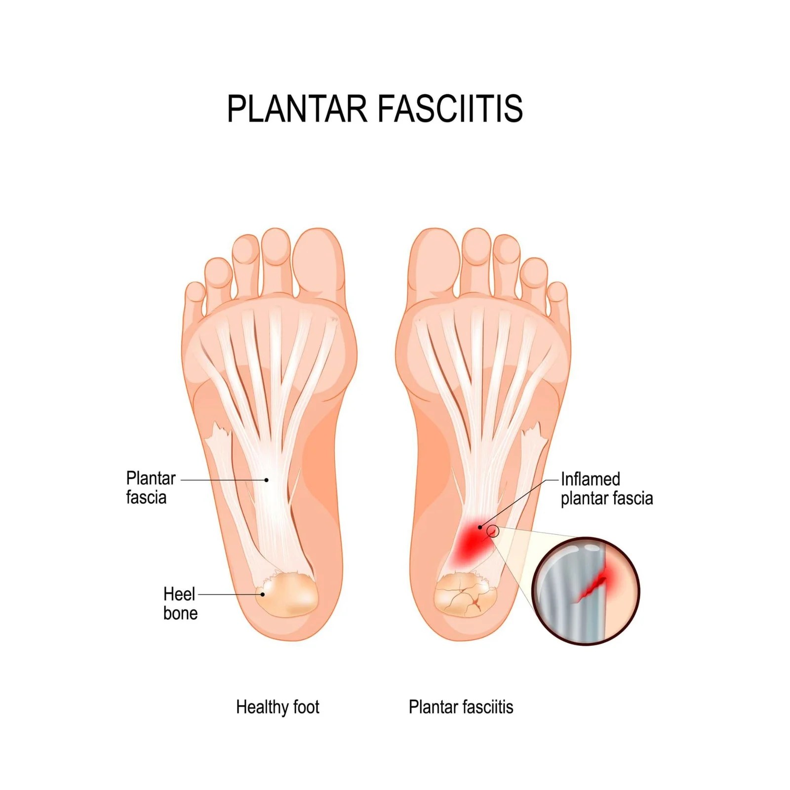 Shockwave Therapy for Plantar fasciitis? Complete Physio