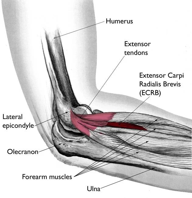 What is Tennis Elbow? Complete Physio