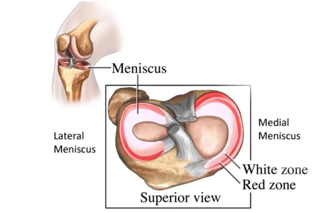 What is a meniscal tear? Complete Physio