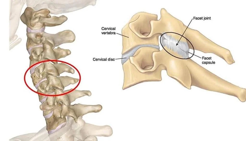 Neck Headache (Cervicogenic Headache CGH) Complete Physio