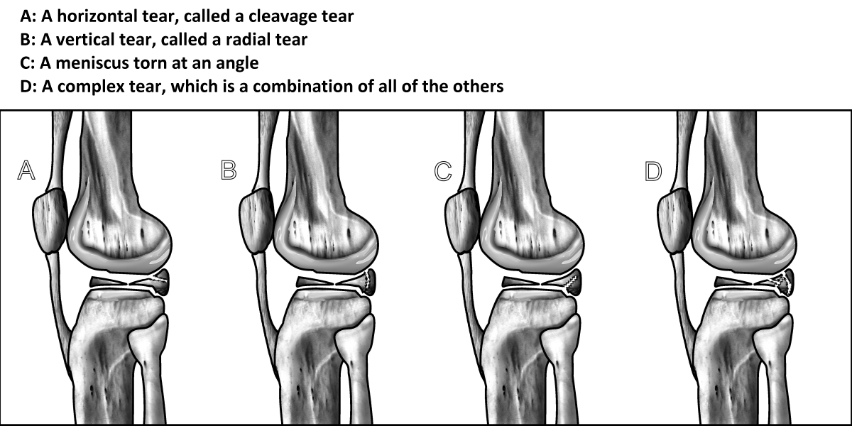 How to Prevent Knee Surgery for a Meniscus Tear CompletePT Pool & Land Physical Therapy