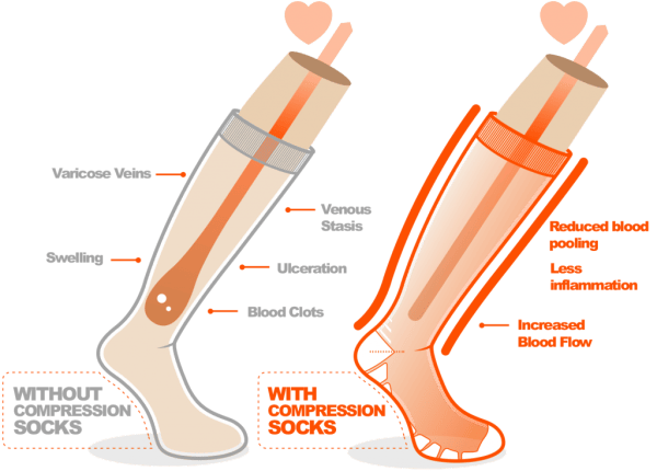 How Long To Wear Compression Socks For Edema? (with Photos)