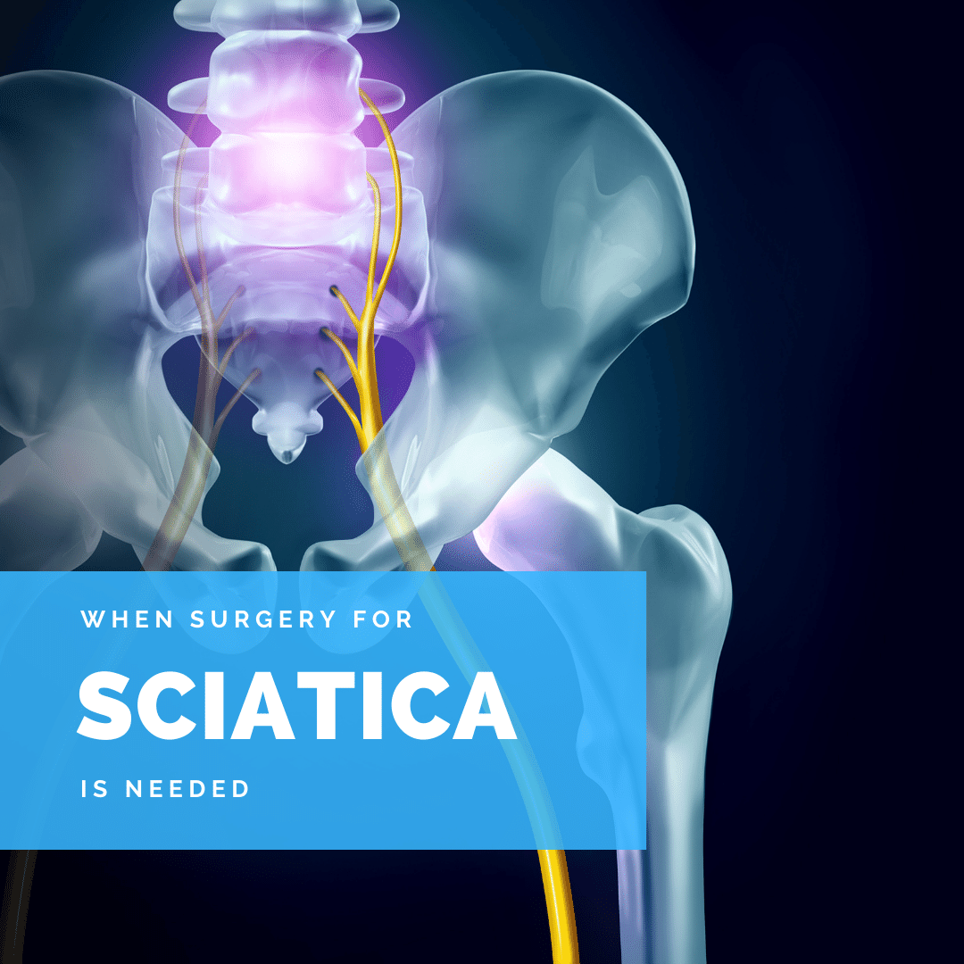 When Surgery Is Needed For Sciatica New Jersey Comprehensive Spine Care