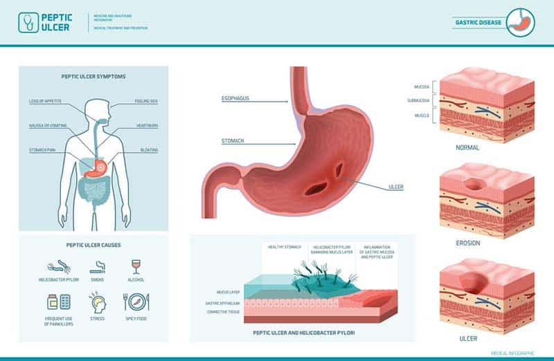 Gastritis Concierge MD LA InHome Medical Services