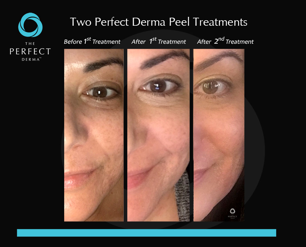 The Perfect Derma Peel in Mission Valley, CA Confident Complexion Skin Care Confident Complexion
