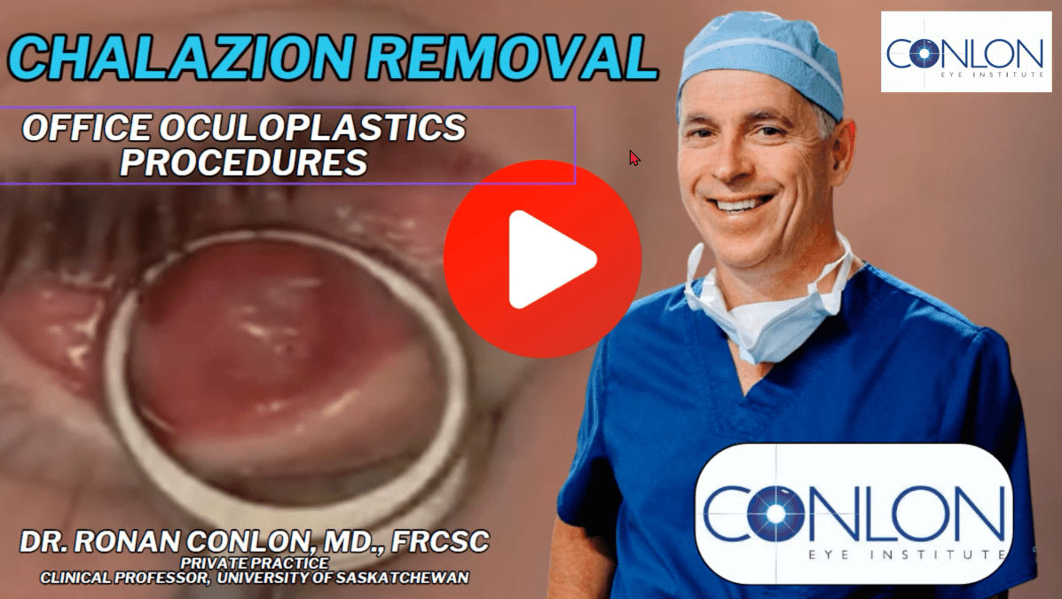 Chalazion Causes, Symptoms, and Treatment Options in 2023