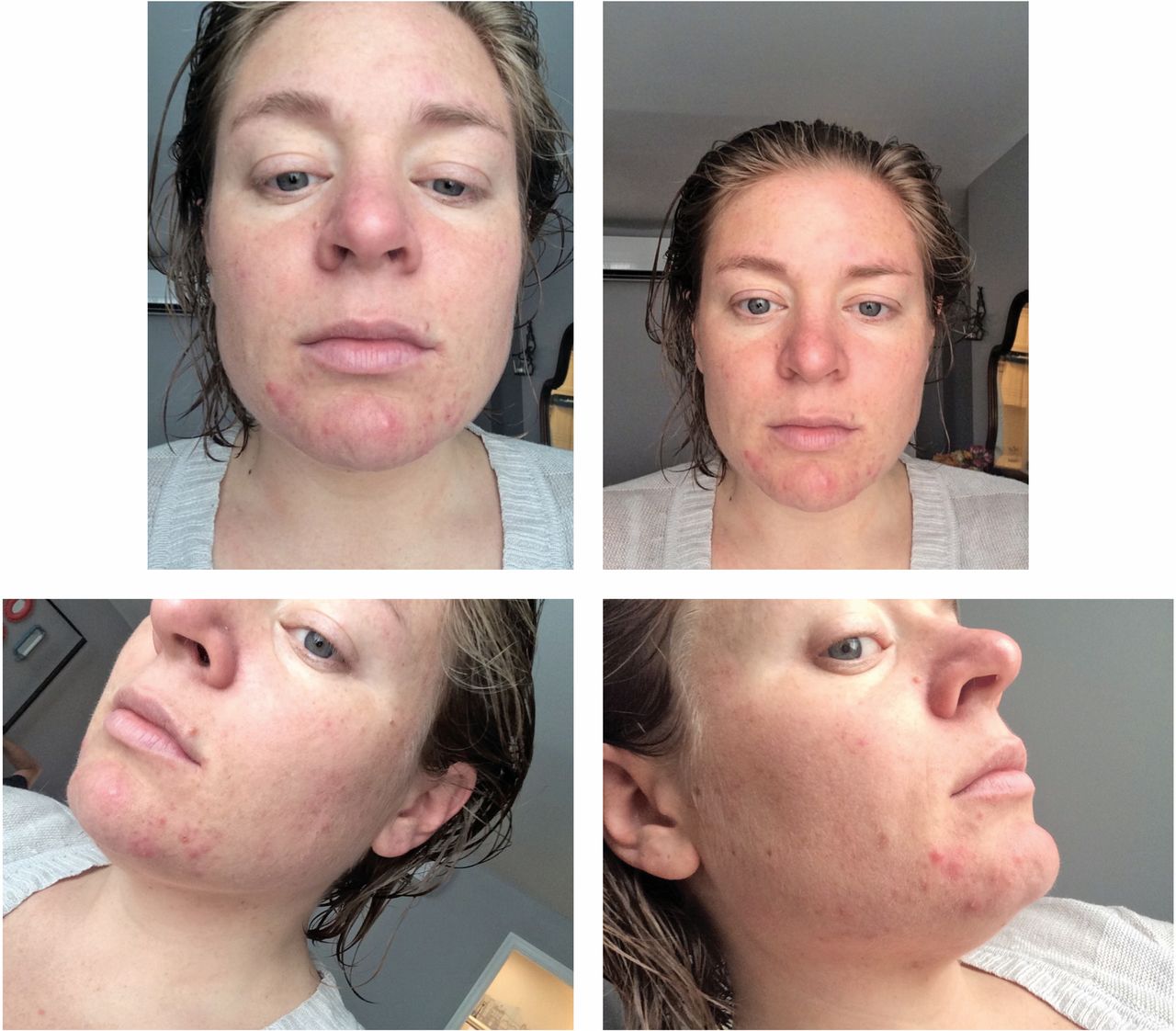 Severe Cystic Acne While Breastfeeding Springer Publishing
