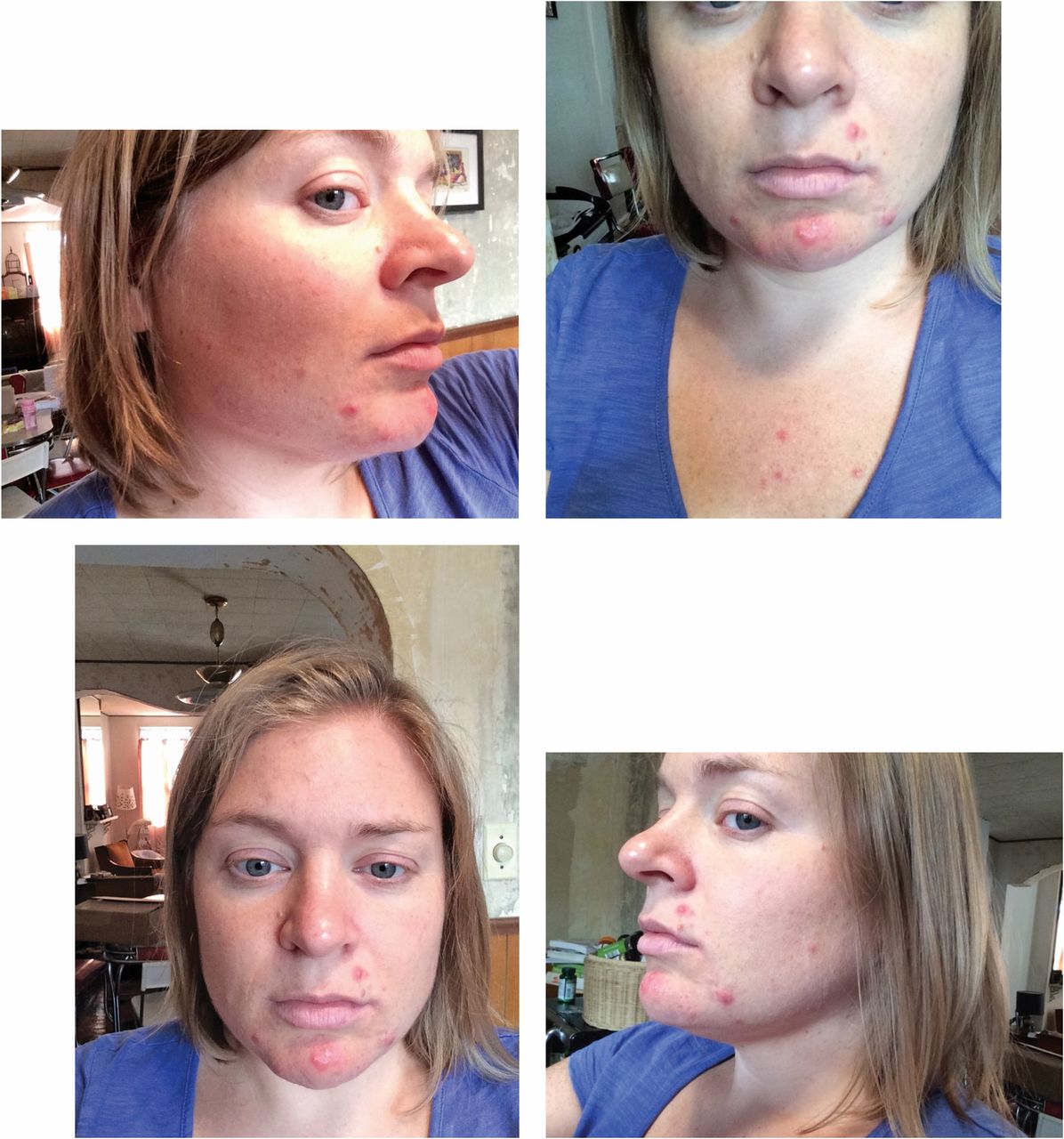 Severe Cystic Acne While Breastfeeding Springer Publishing