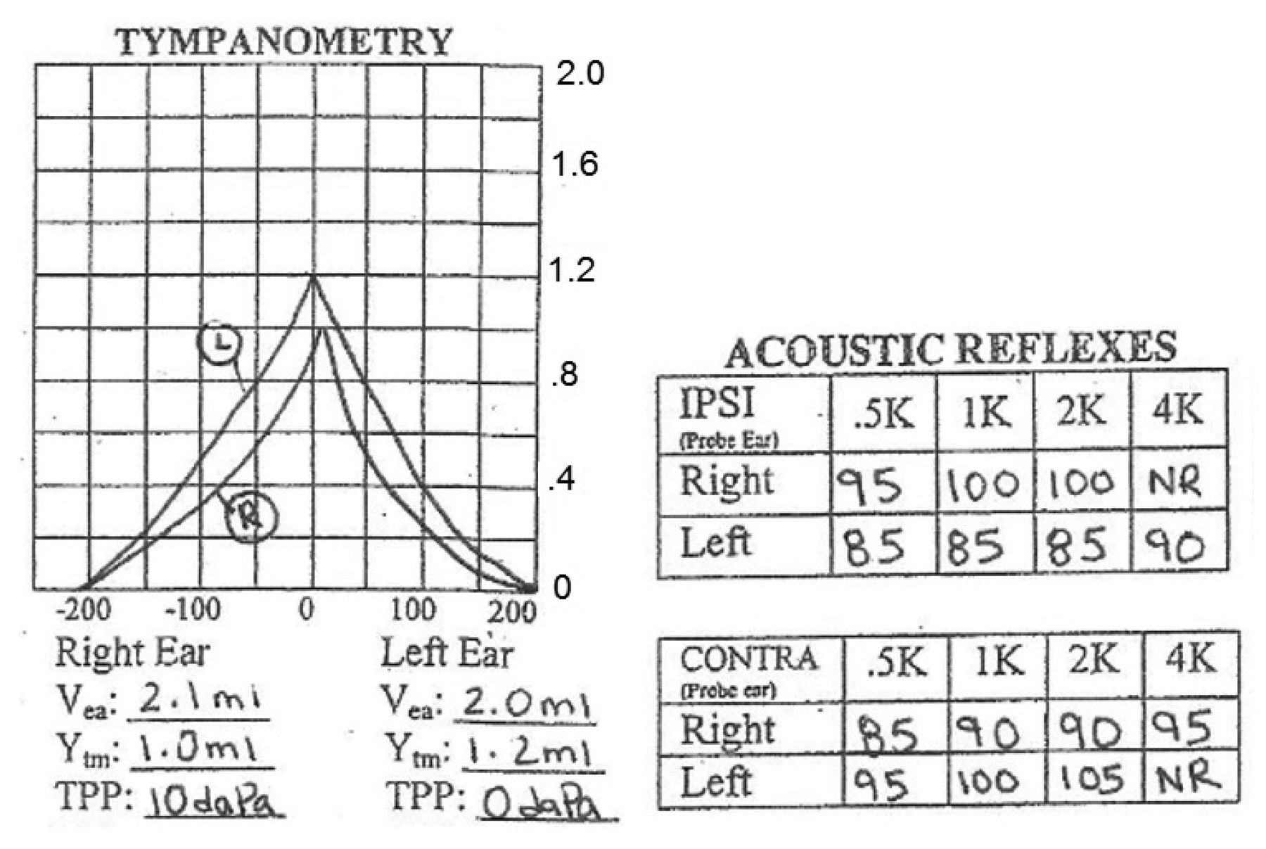 Meniere's Disease Tympanometry Meniere's disease is a disorder of the