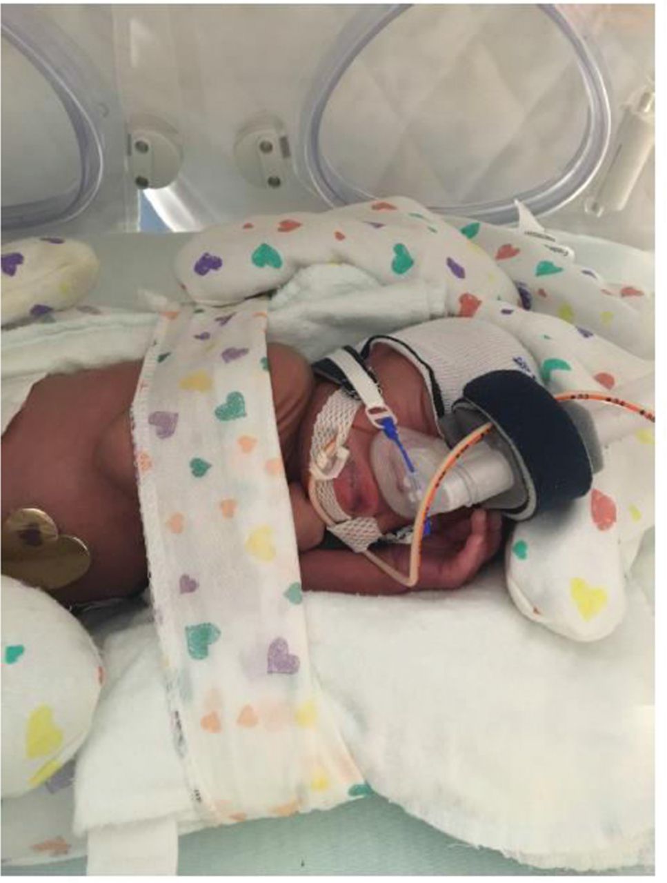 Care of the Neonate on Nasal Continuous Positive Airway Pressure A