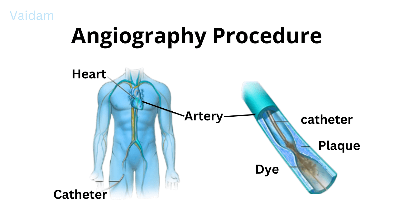 Angiography Cost In South Africa Updated 2024