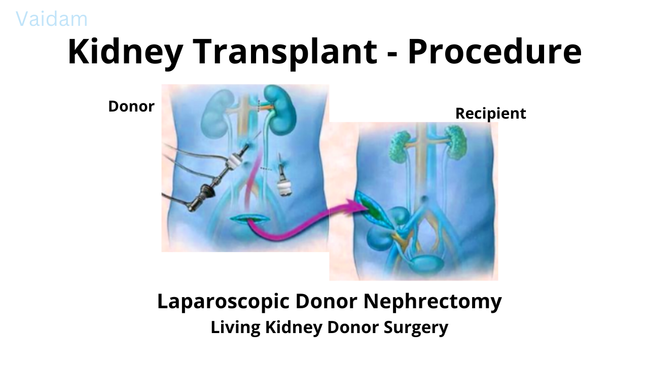 Kidney Transplant Cost In India Updated 2024