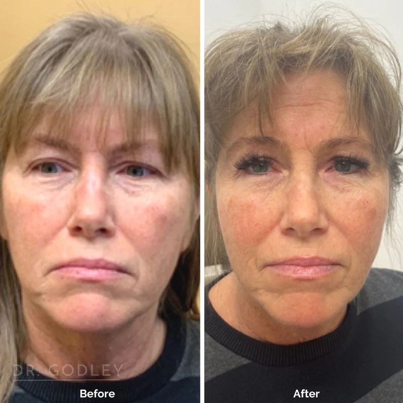 Thread Lift Vancouver & Abbotsford Conquer 180