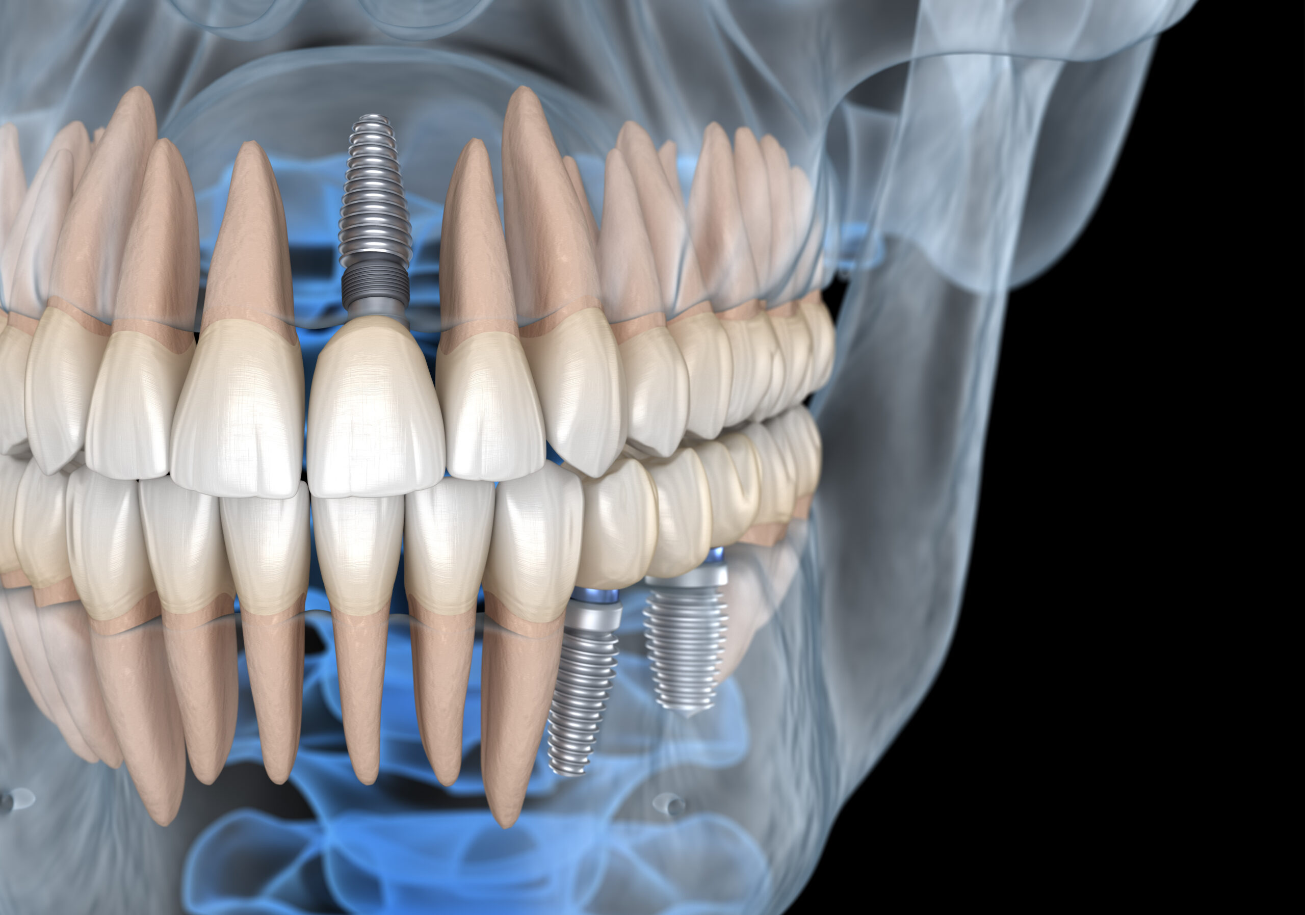 How We Use Advanced Tech To Place Implants Conroe, TX