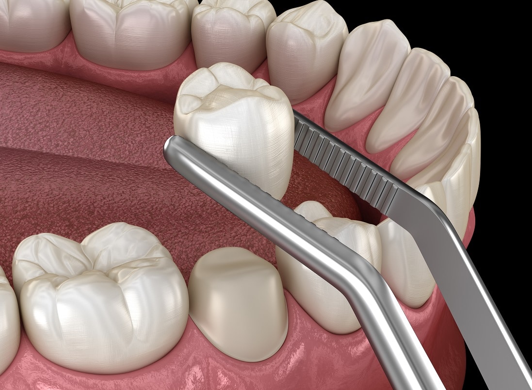 Different Kinds of Problems a Dental Crown Can Solve Conroe, TX