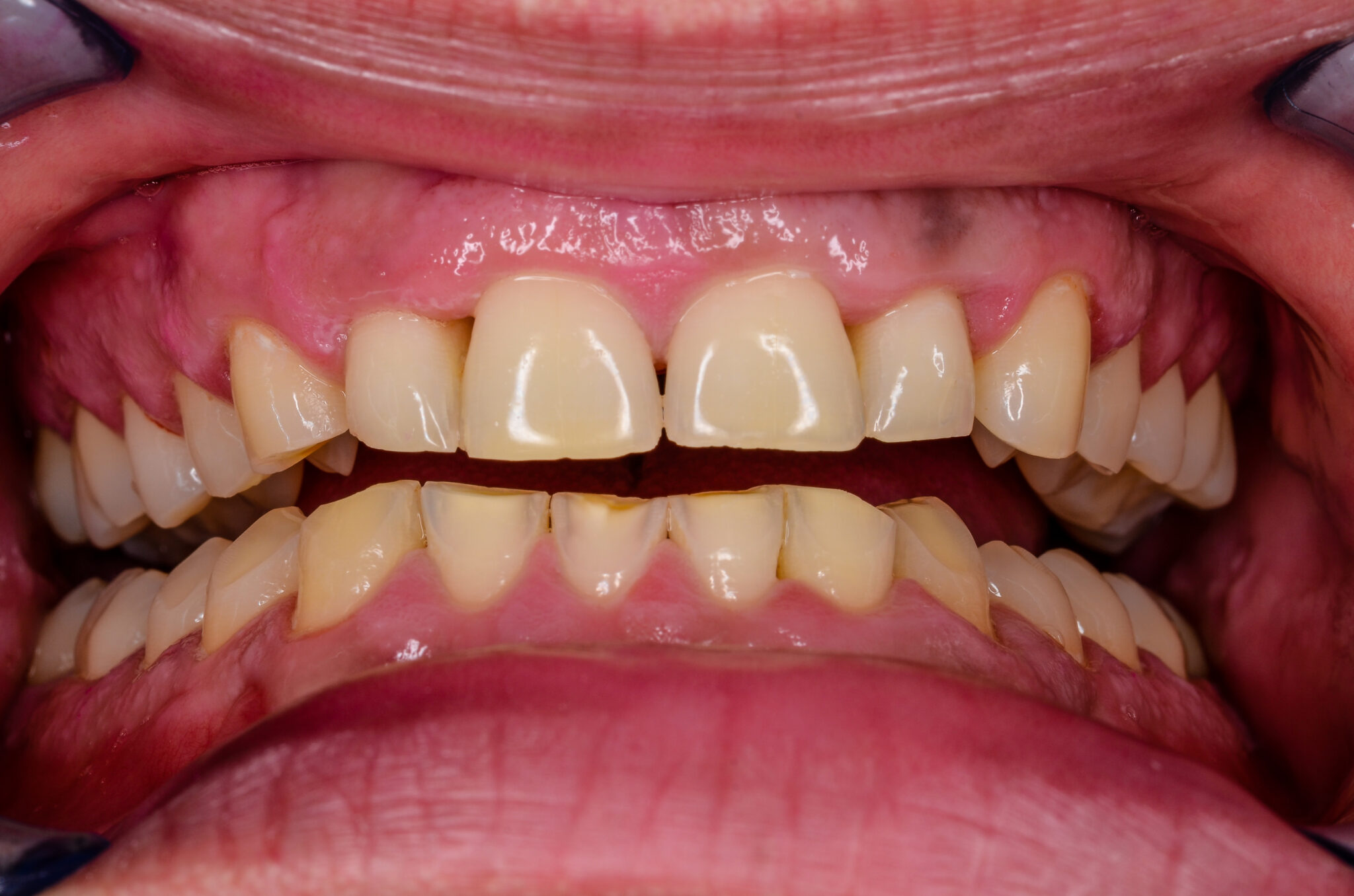 Do You Grind Your Teeth At Night? Conroe, TX