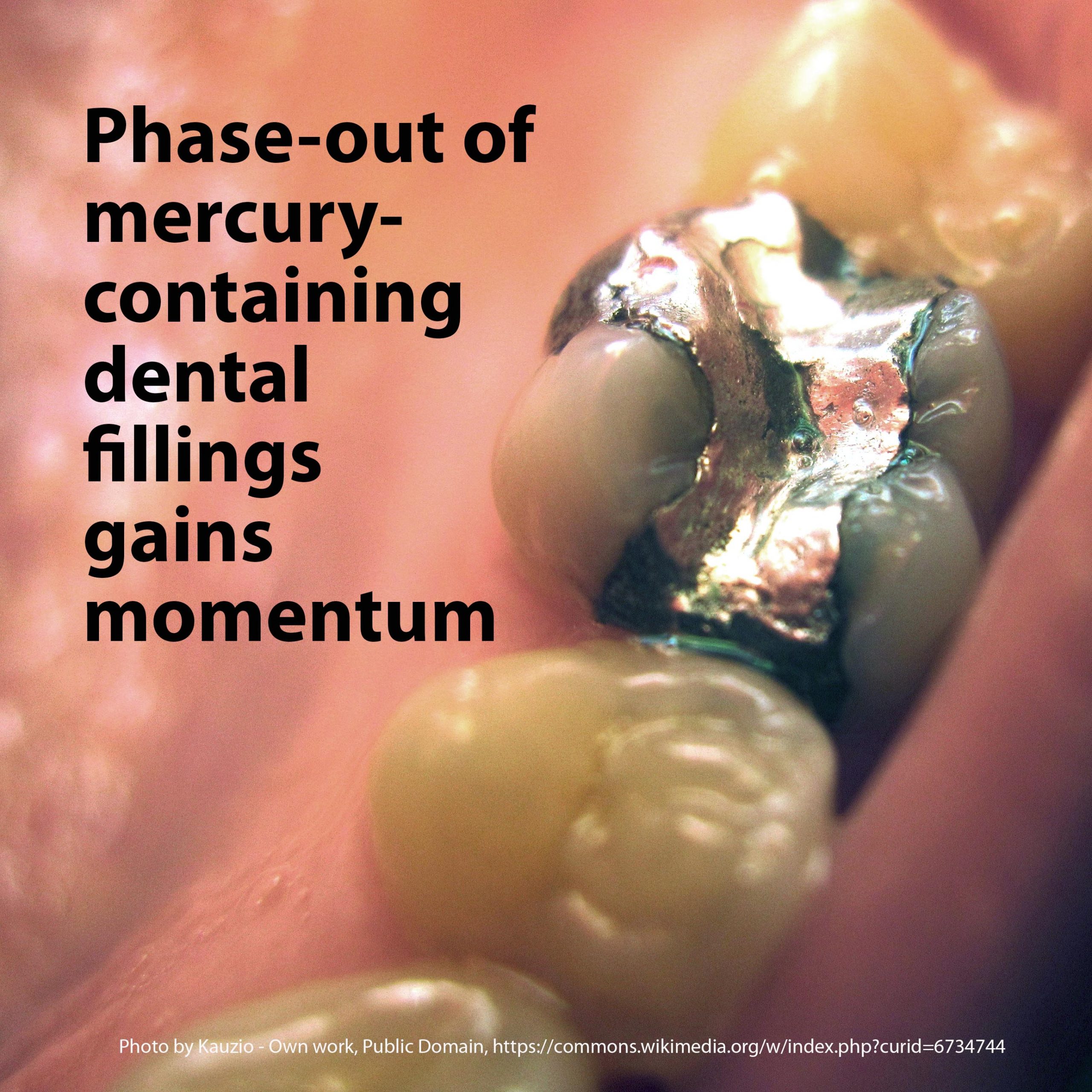 Phaseout of mercurycontaining dental fillings gains momentum