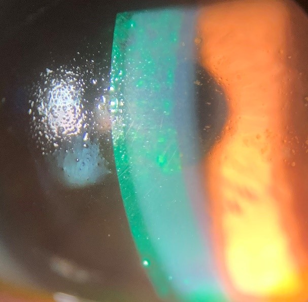 Scleral Lens Update Current and Future Applications Contact Lens Update