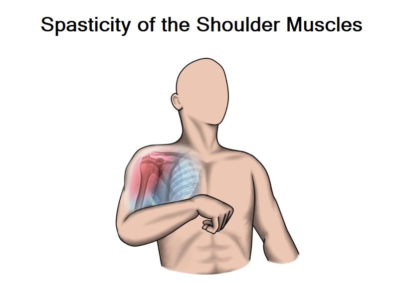Managing Shoulder Pain After Stroke 4 Common Causes and Treatments