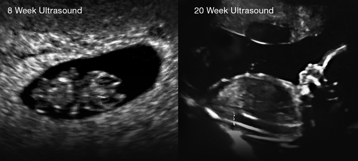 Ultrasound Tests During Pregnancy Reveal More than Gender